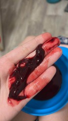 Bleeding and unclear dates in early pregnancy, looking for others' experiences [pics included]