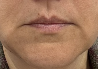 Marionette filler before and afters for those considering