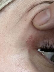 Anyone know what these bumps are by my eye?
