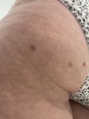 Folliculitis or something else?