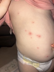 Two year old keeps getting unexplained spots