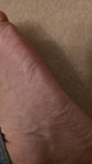 Chronic athlete's foot when antifungal creams worsen neurological side effects
