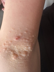 Recurring rash on elbows and knees now bleeding when rubbed
