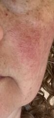 Best coverage for rosacea?