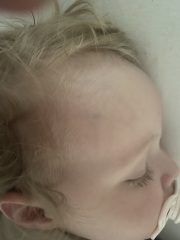 22 month is old bruising - Concerning?