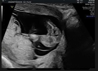 To not want my partner to be an anonymous sperm donor?