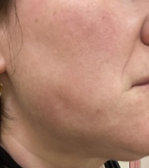 Botox for teeth grinding. How it’s going