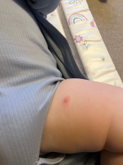 Two year old keeps getting unexplained spots