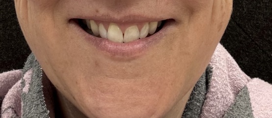 Marionette filler before and afters for those considering