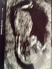 Can anyone give a second opinion on this pregnancy scan image?