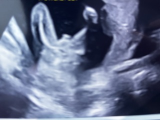 Incorrect gender at 17weeks