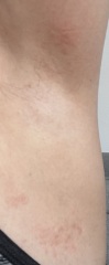 What is this burning rash that’s driving me bananas?
