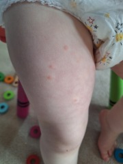 Is this the start of chicken pox or something else? (Pics attached)