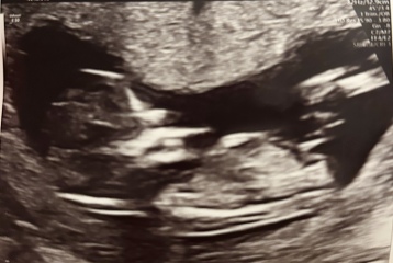 Any guesses on baby's sex from this 12 week scan?