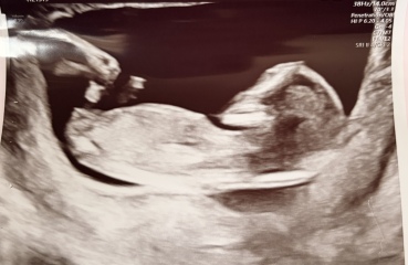 Can anyone guess the baby’s gender from the 13 week nub scan?