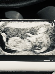 Can anyone give a second opinion on this pregnancy scan image?