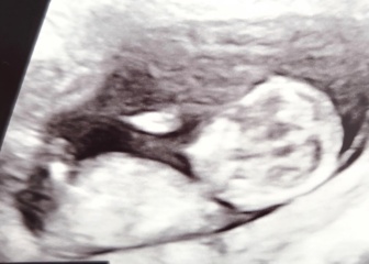 Nub theory 🩷💙