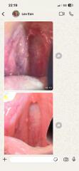 Any dentists about or GPs? Small hard lump roof of mouth