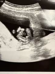 13 weeks - Boy or Girl?