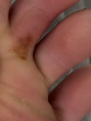 What is this mark under my toe?