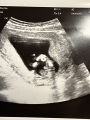 13 weeks - Boy or Girl?