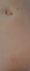 Is this the start of chicken pox or something else? (Pics attached)