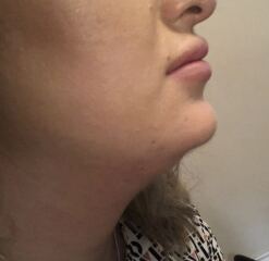 Where to start with surgical options for a weak chin and jawline
