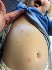 Two year old keeps getting unexplained spots