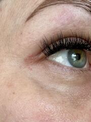 Anyone know what these bumps are by my eye?