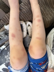 Are these bruises normal in a four-year-old or worth checking?