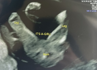 To not want my partner to be an anonymous sperm donor?