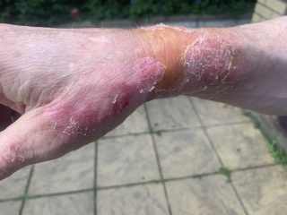 Any medical professionals? Advice on DH severe scald please