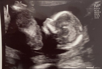 15 week scan - guesses on skull theory or nub theory