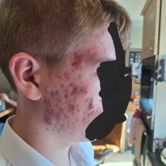 Teenage cystic acne out of control
