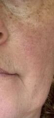 Best coverage for rosacea?