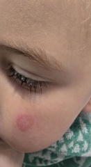 Discoid eczma?