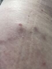 Folliculitis or something else?