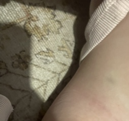 Little bruises in unusual spots - 1yr old.