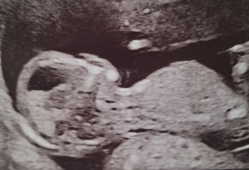 If you have a moment..13 week scan, baby kept moving and angling away 😅 so each pic looks so different. Gender guesses please 🙏 🙂 💕