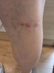 Sores on back of knees, any ideas? Pic attached