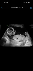 Told boy at 17-week scan but worried the sex may be wrong