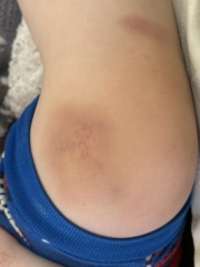 Are these bruises normal in a four-year-old or worth checking?