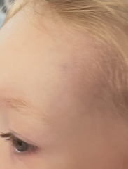 22 month is old bruising - Concerning?