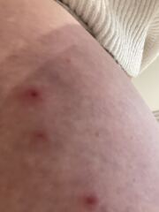 Folliculitis or something else?