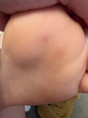 What are these on my son’s foot..