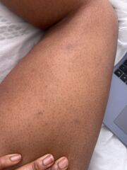 Purple vains on leg?