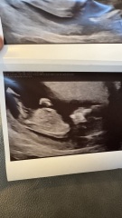 Did anyone have a boy nub on their 12 week scan but end up having a girl?