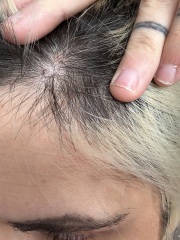 Small hard scalp lump for years, now worried after Googling