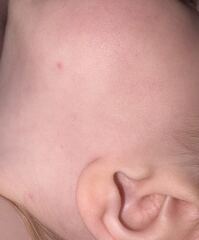 Do you think looks like chickenpox?