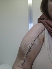Broken arm and dont trust Dr's after they've consistently messed up.